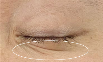 症例①：目元　施術前