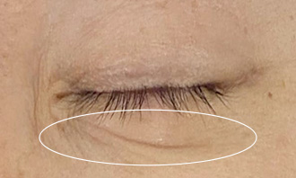 症例①：目元　施術直後