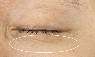 症例①：目元　4週間後