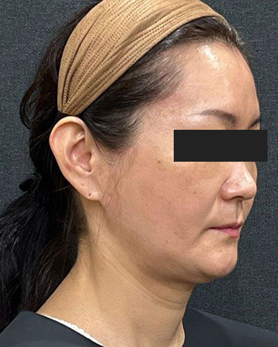 症例②：顔　施術前