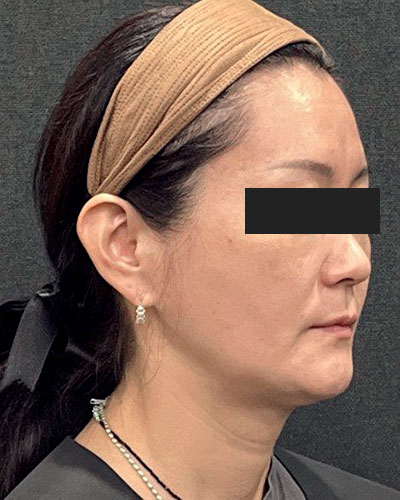 症例②：顔　4ケ月後